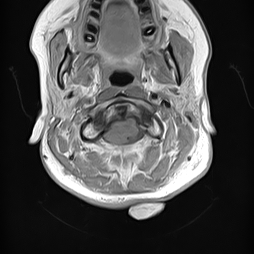 File:Neurofibromatosis type 2 (Radiopaedia 66211-75403 Axial T1 C+ 3).jpg