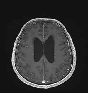 Neurofibromatosis type 2 (Radiopaedia 79097-92049 Axial T1 C+ 133).jpg