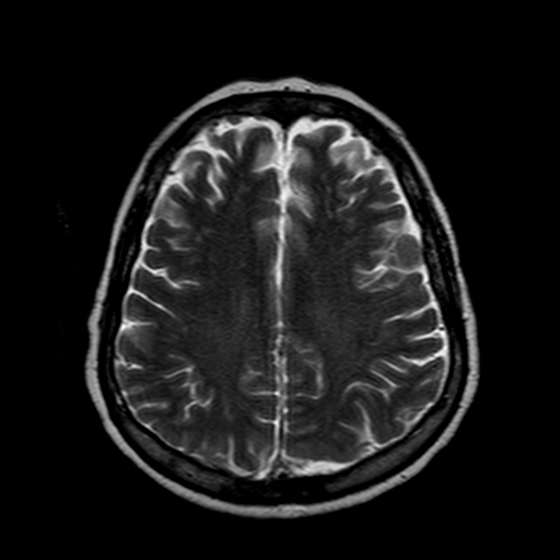 File:Neurofibromatosis type 2 (Radiopaedia 8713-9518 Axial T2 8).jpg
