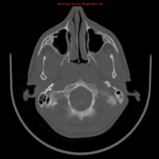 File:Neurofibromatosis type 2 (Radiopaedia 8953-9732 Axial bone window 1).jpg