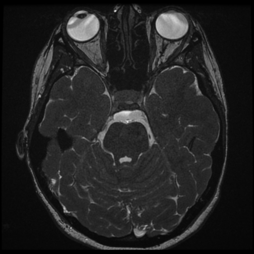 File:Neurofibromatosis type 2 - bilateral acoustic neuromata (Radiopaedia 40060-42566 Axial FIESTA 64).png