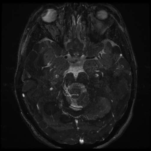 Neurofibromatosis type 2 - bilateral acoustic neuromata (Radiopaedia 40060-42566 Axial FIESTA 82).png