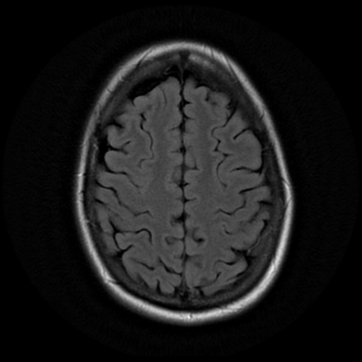 File:Neurofibromatosis type 2 - bilateral acoustic neuromata (Radiopaedia 40060-42566 Axial FLAIR 17).png