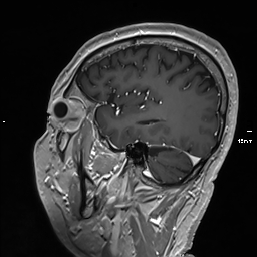 Neurosarcoidosis - involvement of the mesial temporal lobes (Radiopaedia 67429-76820 Sagittal T1 C+ 126).jpg
