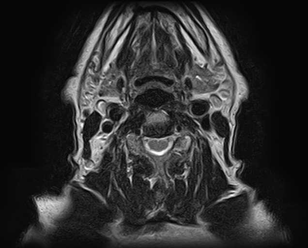 File:Non-Hodgkin lymphoma - parotid gland (Radiopaedia 71531-81890 Axial T2 6).jpg