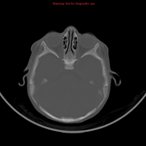 File:Non-accidental injury - bilateral subdural with acute blood (Radiopaedia 10236-10765 Axial bone window 7).jpg