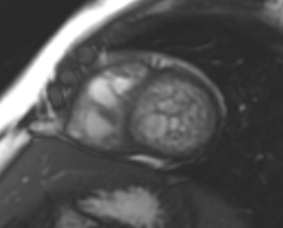 File:Non-compaction of the left ventricle (Radiopaedia 69436-79314 Short axis cine 98).jpg