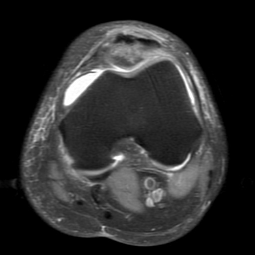 File:Non-displaced patella fracture (Radiopaedia 15932-15582 Axial PD fat sat 10).jpg
