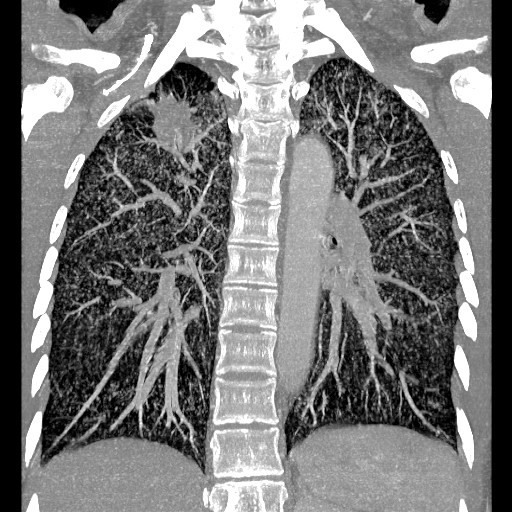 File:Non-small cell lung cancer with miliary metastases (Radiopaedia 23995-24193 Coronal lung window 10).jpg