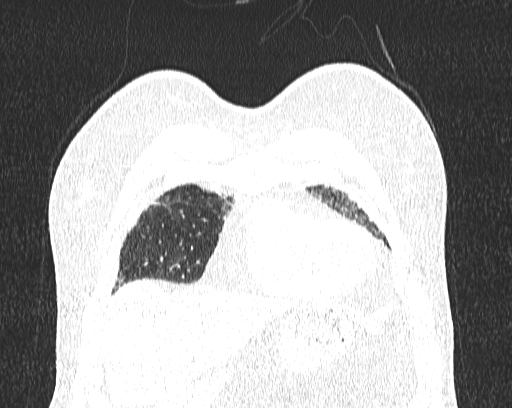 Non-specific interstitial pneumonia (NSIP) (Radiopaedia 68599-78228 Coronal lung window 8).jpg