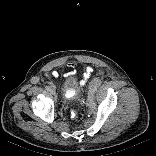 Non Hodgkin lymphoma in a patient with ankylosing spondylitis (Radiopaedia 84323-99621 Axial C+ delayed 70).jpg