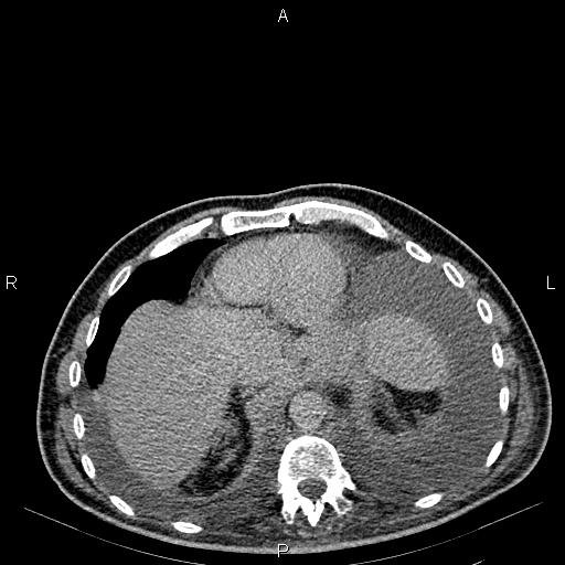 Non Hodgkin lymphoma in a patient with ankylosing spondylitis (Radiopaedia 84323-99621 Axial C+ delayed 9).jpg