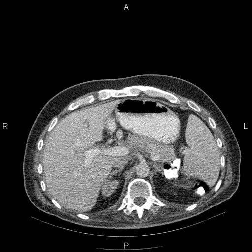 File:Non Hodgkin lymphoma in a patient with ankylosing spondylitis (Radiopaedia 84323-99624 B 30).jpg