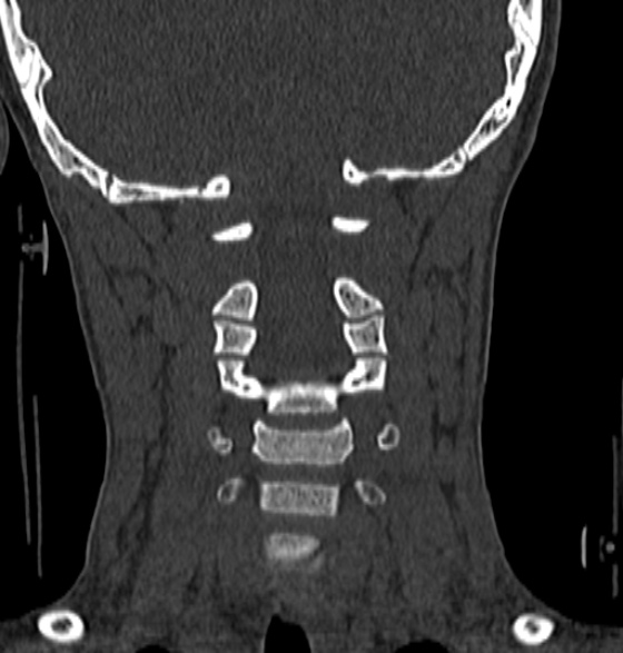 File:Normal CT cervical spine - 12-year-old (Radiopaedia 55352-61775 Coronal bone window 110).jpg