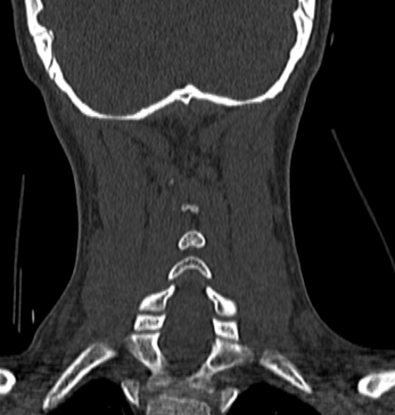 File:Normal CT cervical spine - 12-year-old (Radiopaedia 55352-61775 Coronal bone window 169).jpg