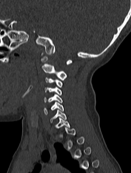 Normal CT cervical spine - pediatric (Radiopaedia 52549-58462 Sagittal bone window 154).jpg