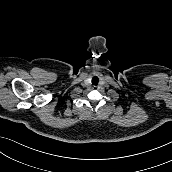 Normal CT chest- adult female (Radiopaedia 52522-58428 Axial non-contrast 3).jpg