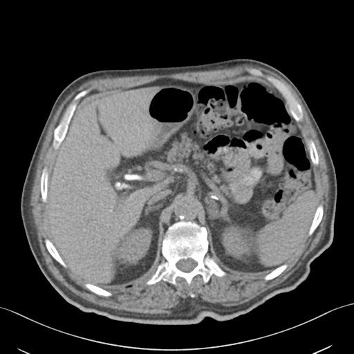 File:Normal CT intravenous cholangiogram (Radiopaedia 38199-40208 Coronal IVC 1).png