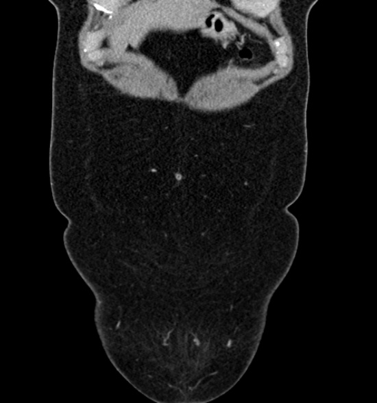 Normal CT intravenous urogram (Radiopaedia 39444-41759 A 165).jpg
