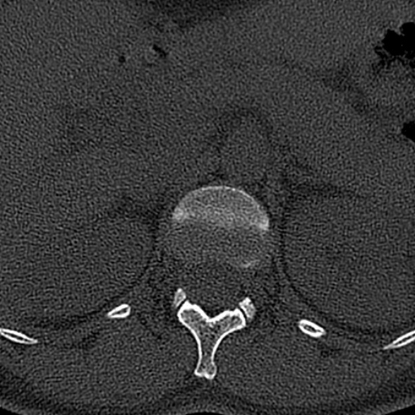 File:Normal CT lumbar spine (Radiopaedia 53981-60118 Axial bone window 7).jpg