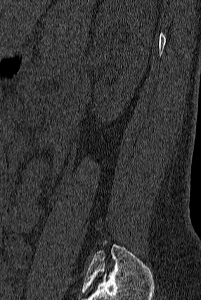 File:Normal CT lumbar spine (Radiopaedia 53981-60118 Sagittal bone window 88).jpg