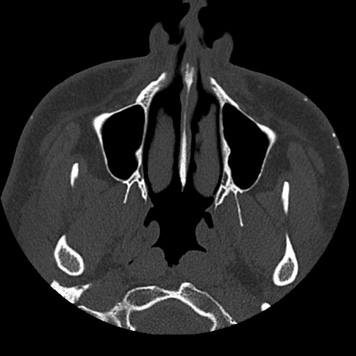 Normal CT paranasal sinuses (Radiopaedia 42286-45390 Axial bone window 88).jpg