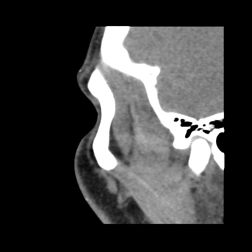 Normal CT paranasal sinuses (Radiopaedia 42286-45390 F 27).jpg