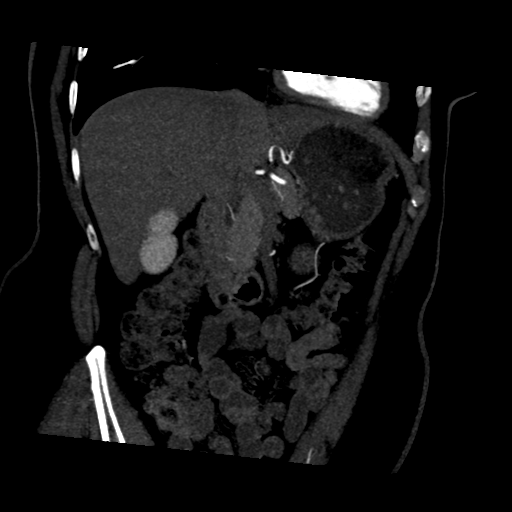 File:Normal CT renal artery angiogram (Radiopaedia 38727-40889 D 6).png
