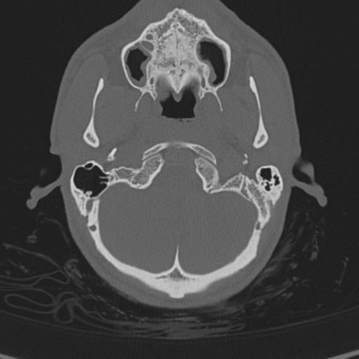 Normal CT skull (Radiopaedia 40798-43459 A 19).png