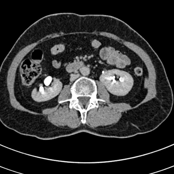 File:Normal CT split bolus study of the renal tract (Radiopaedia 48631-53634 Axial split bolus 120).jpg