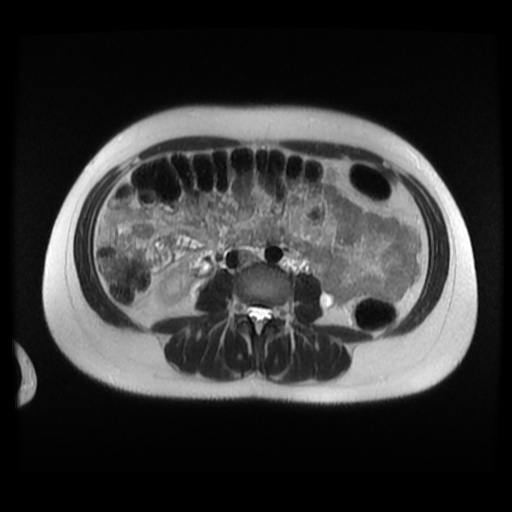 Normal MRI abdomen in pregnancy (Radiopaedia 88003-104546 Axial T2 20).jpg
