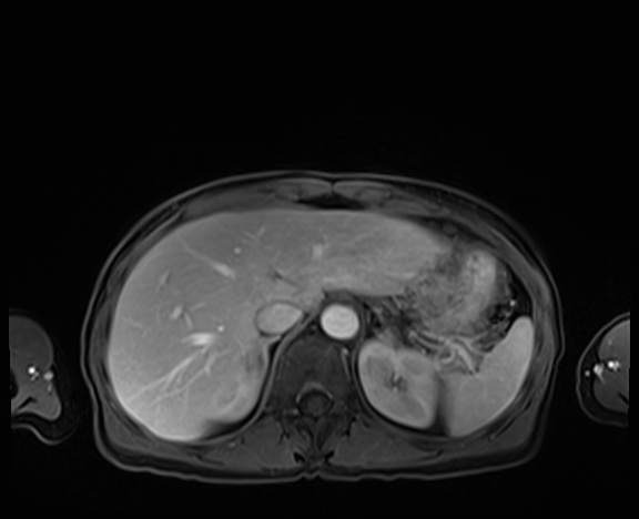 Normal adrenal glands MRI (Radiopaedia 82017-96004 K 21).jpg