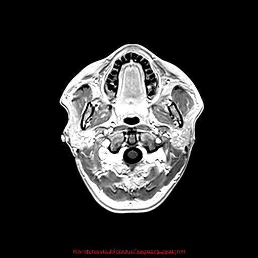 Normal adult brain MRI (non-enhanced and contrast-enhanced) (Radiopaedia 75262-86379 Axial T1 C+ 31).jpg