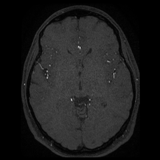 Normal brain MRA (Radiopaedia 41046-43793 Axial MRA 30).png