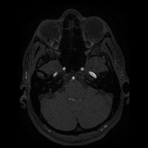 Normal brain MRA (Radiopaedia 41046-43793 Axial MRA 91).png