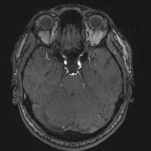 Normal brain MRI including MRA (Radiopaedia 48748-53763 Axial MRA 72).jpg