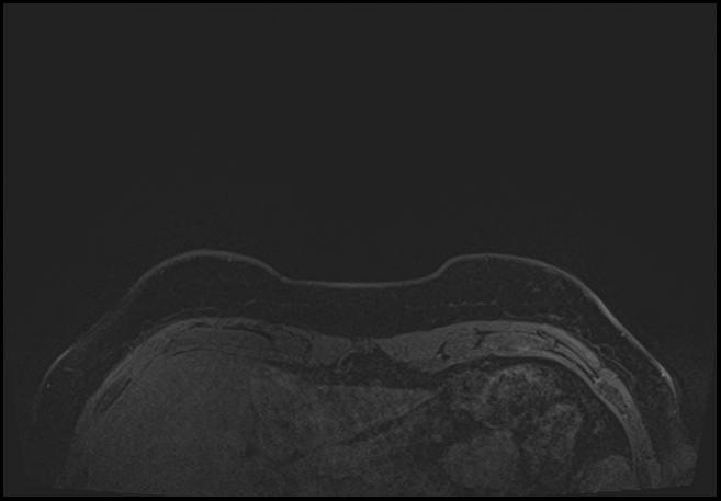 Normal breast MRI - dense breasts (Radiopaedia 80454-93850 C 3).jpg