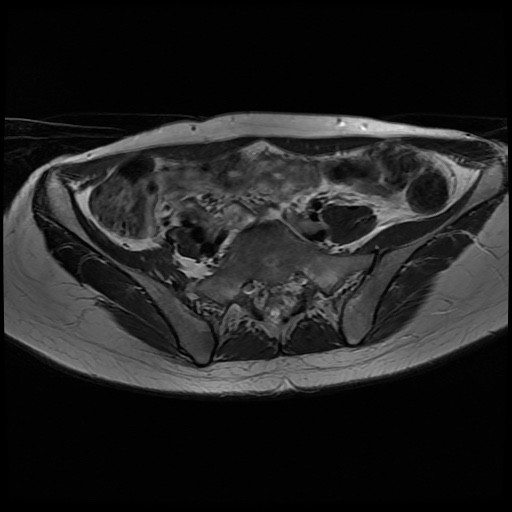 File:Normal female pelvis MRI (retroverted uterus) (Radiopaedia 61832-69933 Axial T2 7).jpg