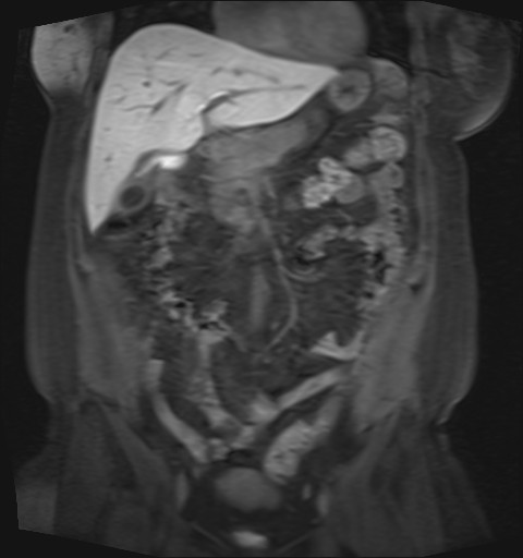 File:Normal hepatobiliary phase liver MRI (Radiopaedia 58968-66230 B 34).jpg