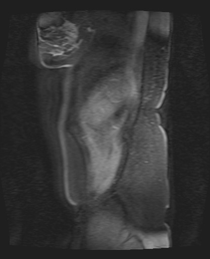 File:Normal hepatobiliary phase liver MRI (Radiopaedia 58968-66230 C 1).jpg