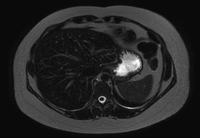 File:Normal liver MRI with Gadolinium (Radiopaedia 58913-66163 E 26).jpg