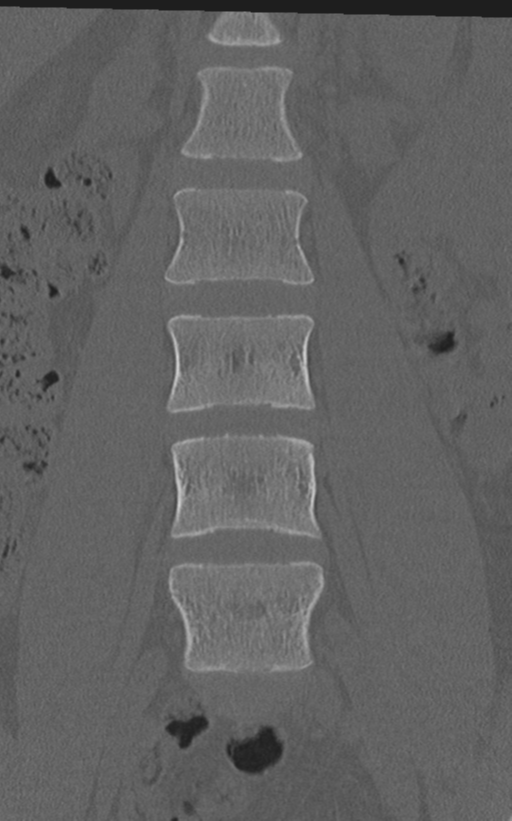 Normal lumbar spine CT (Radiopaedia 46533-50986 Coronal bone window 27).png