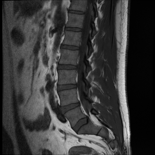 File:Normal lumbar spine MRI (Radiopaedia 35543-37039 Sagittal T1 5).png
