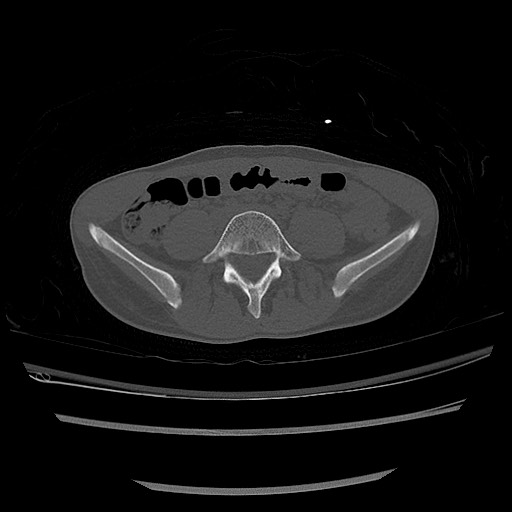 Normal pelvis CT (Radiopaedia 51471-57236 Axial bone window 10).jpg