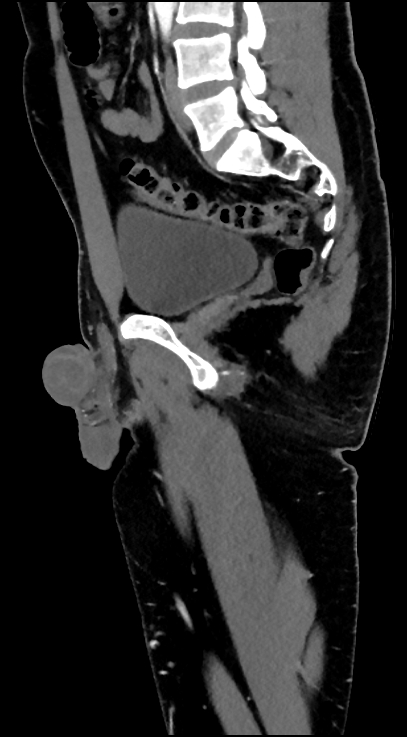 Normal pelvis CT angiogram (Radiopaedia 84966-100481 C 61).jpg