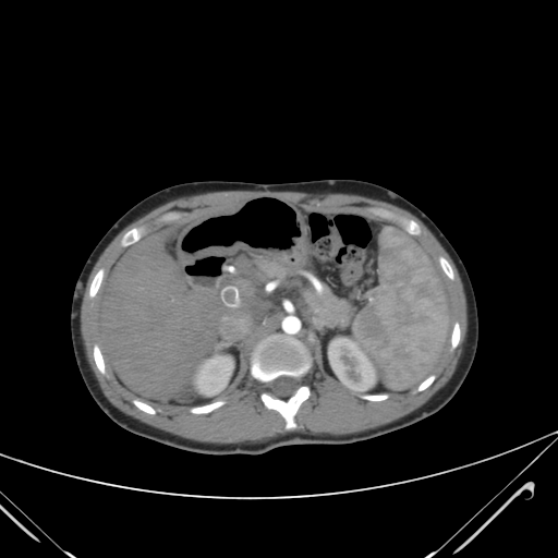 File:Nutmeg liver- Budd-Chiari syndrome (Radiopaedia 46234-50635 A 26).png