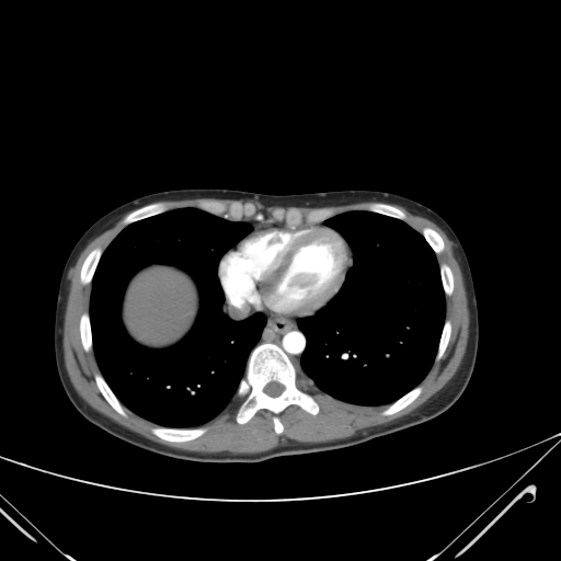File:Nutmeg liver- Budd-Chiari syndrome (Radiopaedia 46234-50635 A 3).png