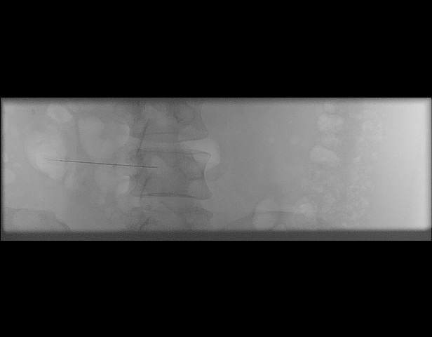 File:Oblique sublaminar lumbar puncture (Radiopaedia 90103-107280 A 39).jpeg