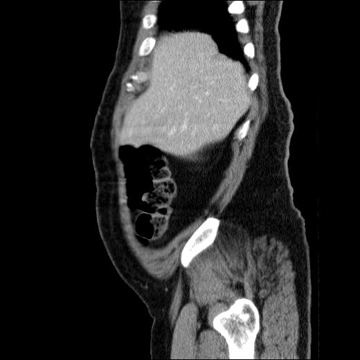 Obstructing ureteric calculus (Radiopaedia 49281-54373 C 75).jpg
