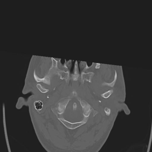 File:Obstructive hydrocephalus (Radiopaedia 30453-31119 Axial bone window 29).jpg